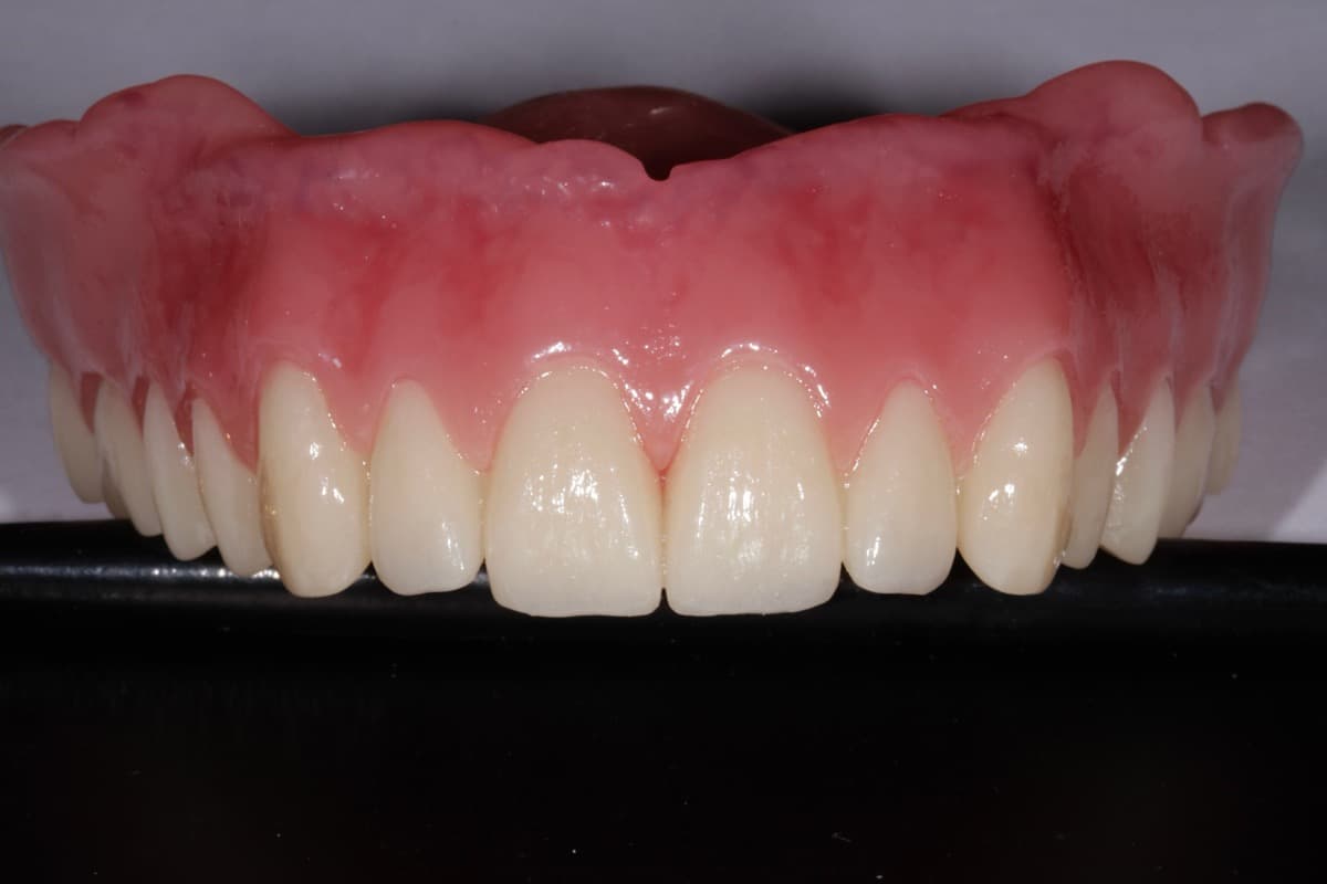 Full Denture Case 2