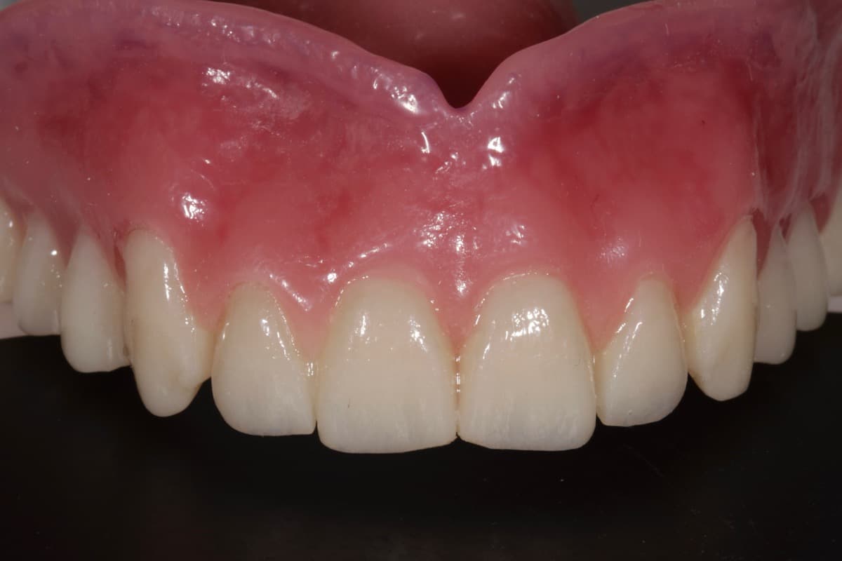 Full Denture Case 3