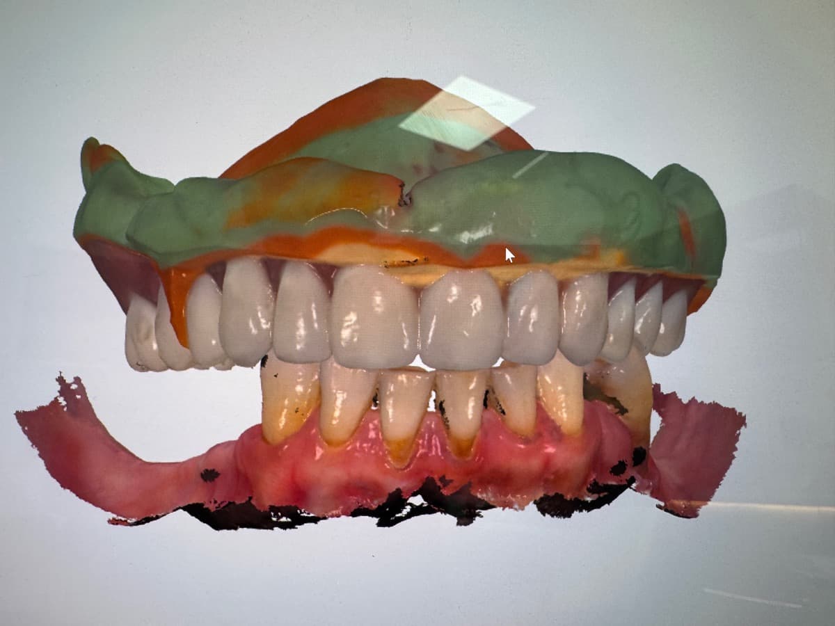 Full Denture Case 4