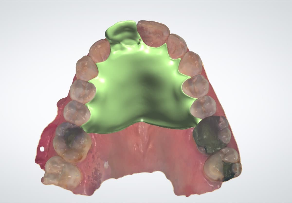 Partial Denture Case 4